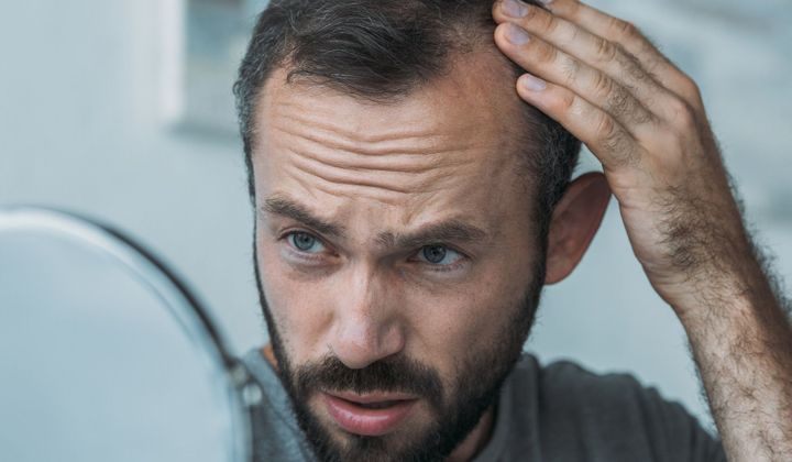 alopecie chute cheveux